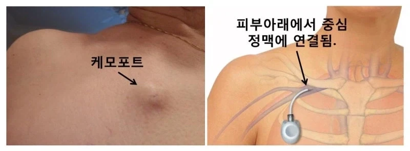 부작용 꽤나 크지만 그래도 사용하는 주사법_1.webp