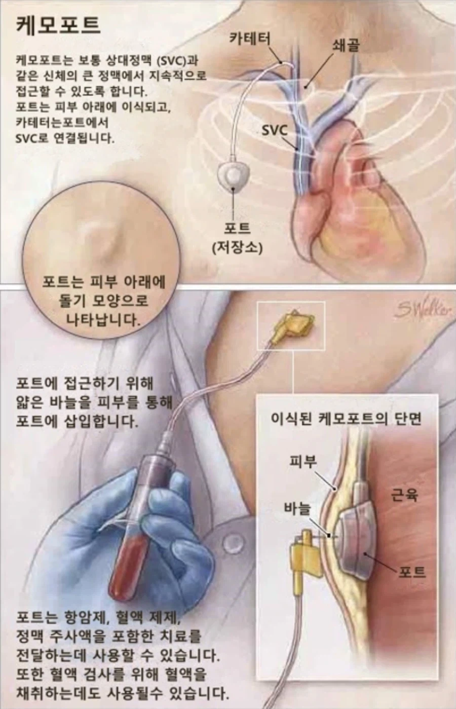 부작용 꽤나 크지만 그래도 사용하는 주사법_3.webp