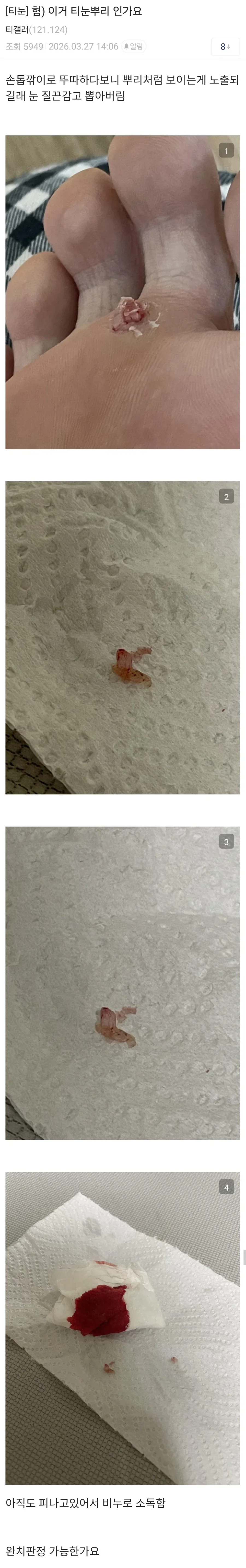 티눈제거 레전드_5.webp