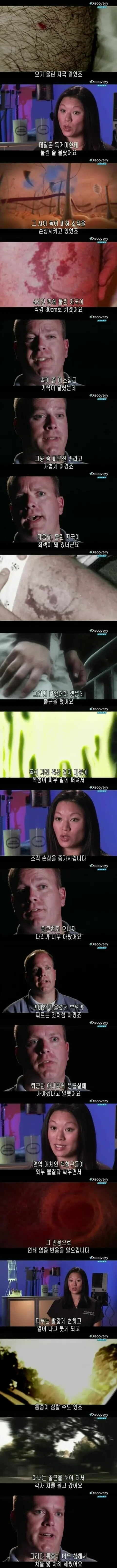 [극혐] 독거미한테 물려서 피부가 괴사한 사례.jpg_3.jpg