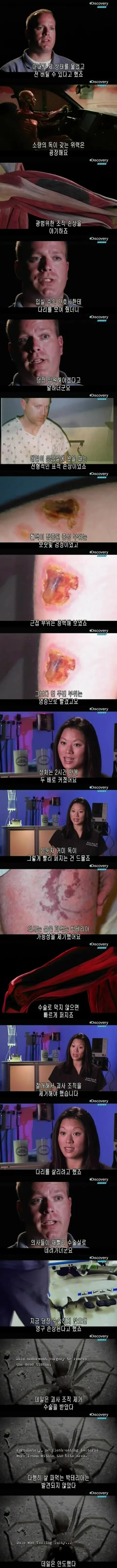 [극혐] 독거미한테 물려서 피부가 괴사한 사례.jpg_4.jpg