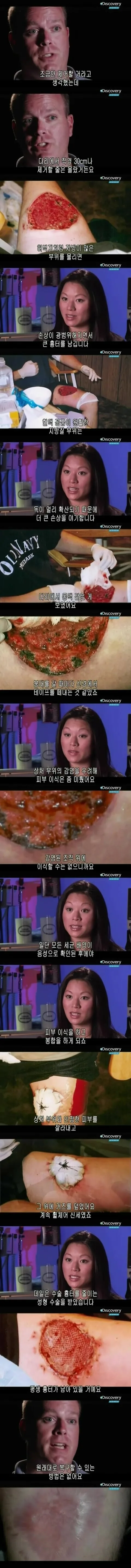 [극혐] 독거미한테 물려서 피부가 괴사한 사례.jpg_6.jpg