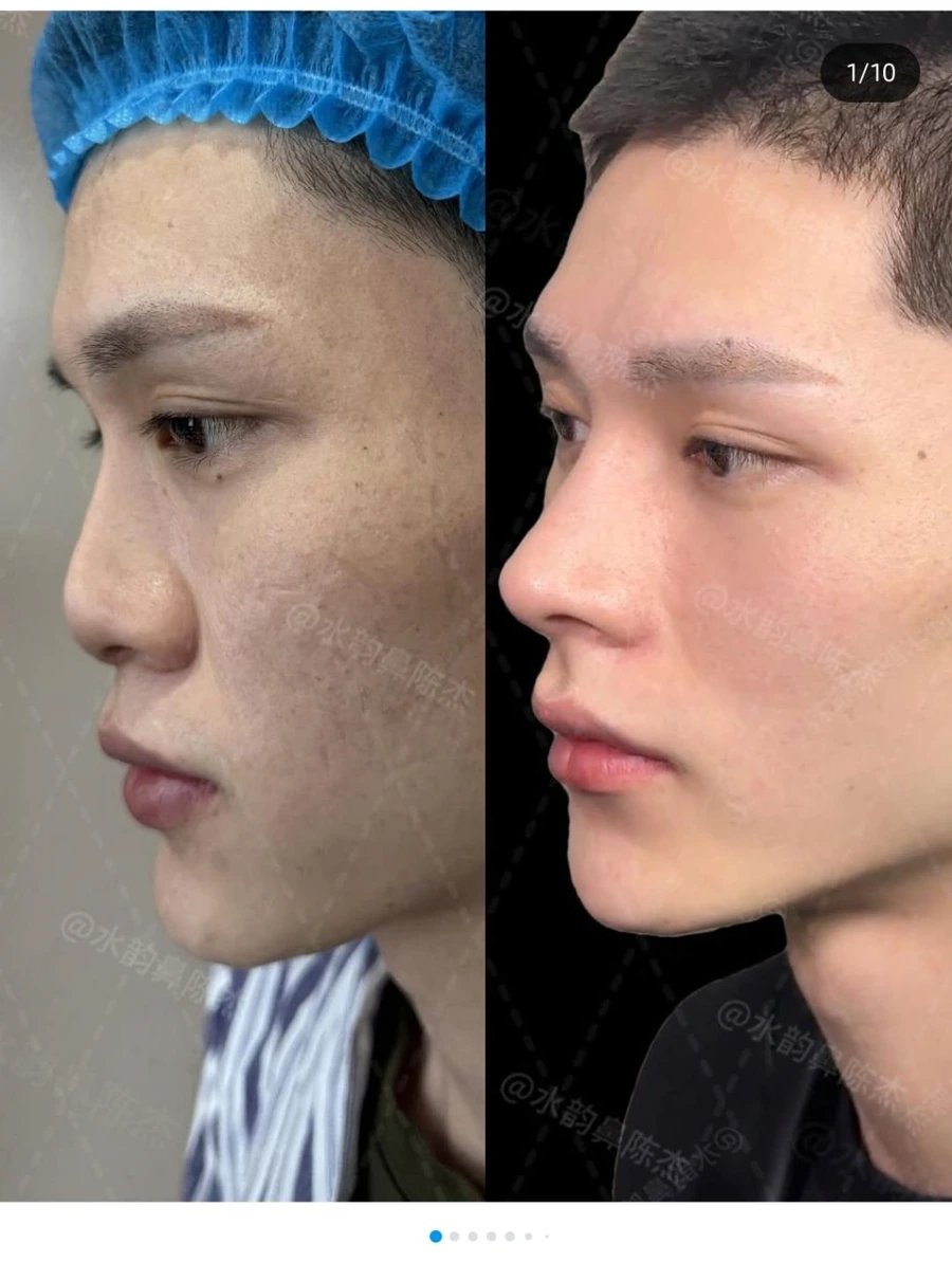image.png SNS에서 뽑은 남자 코 성형 레전드 비포에프터.jpg