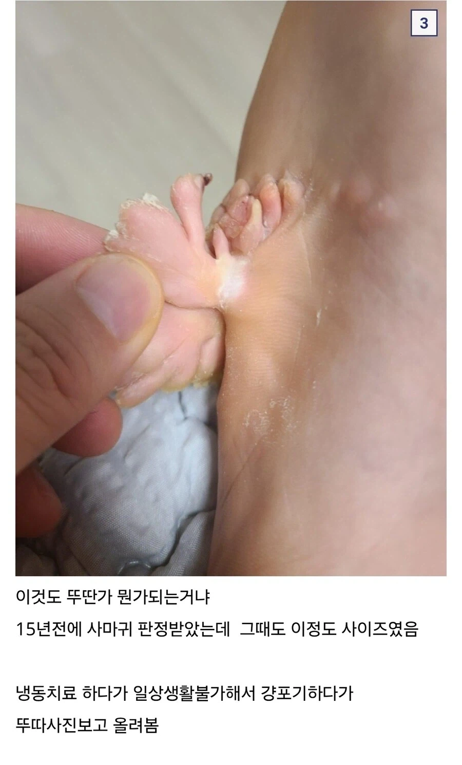혐) 티눈갤 전설 도래창 사마귀_2.webp