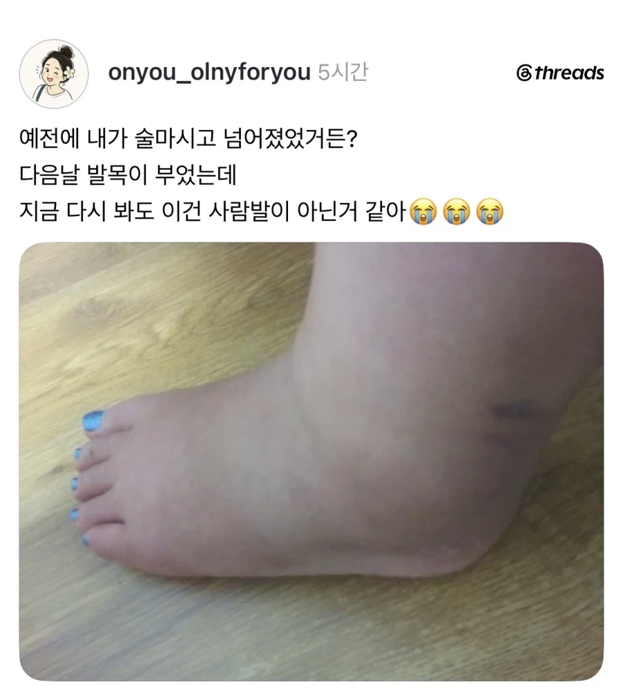 발목 부었을 때 사진.jpg_1.webp