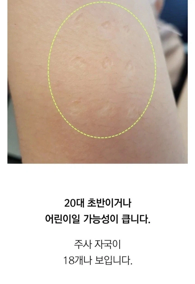 불주사 자국으로 보는 세대 판별법.jpg_3.webp
