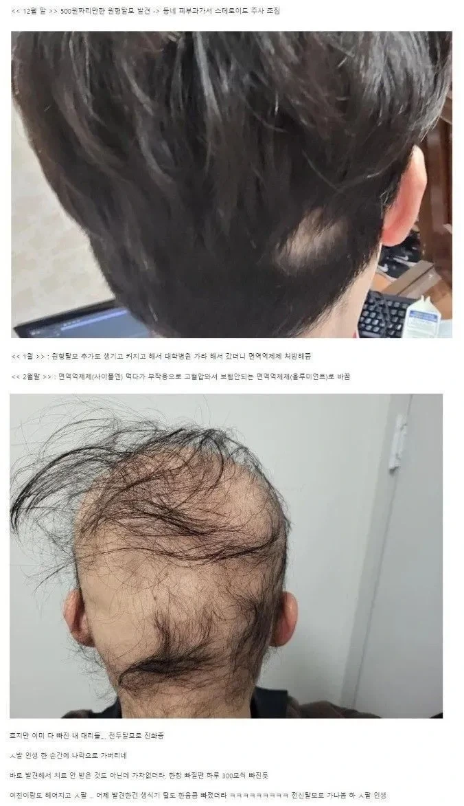 디시 탈모갤의 전설
