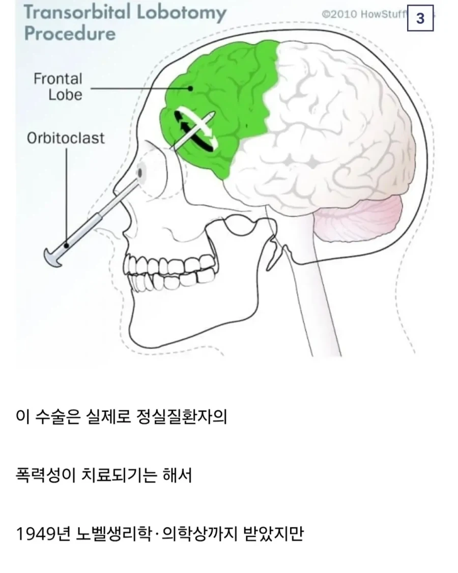 의외로 인류가 조현병을 치료했던 유일한 방법.jpg - 이미지 4