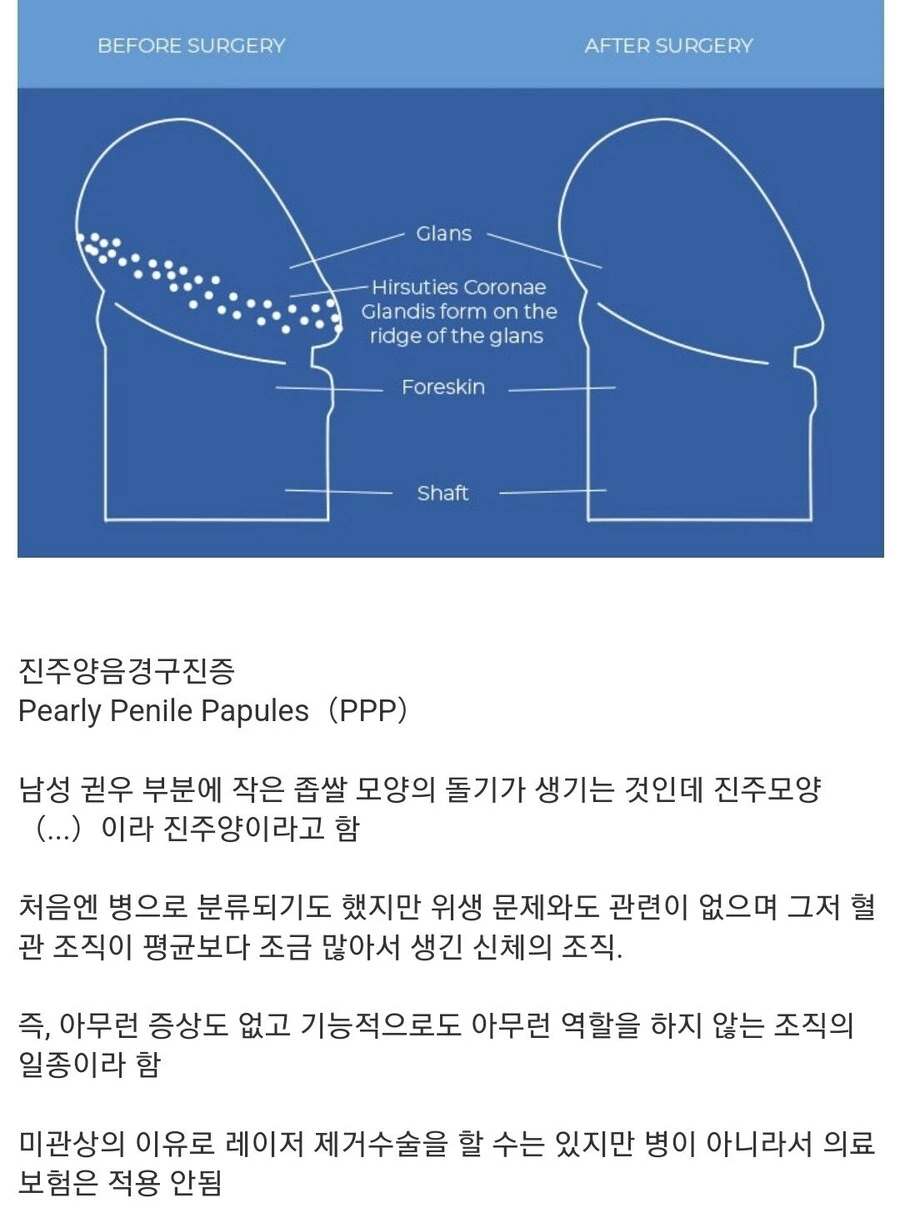 성인남성 30%가 고추, 귀두에 가지고 있는 것.jpg