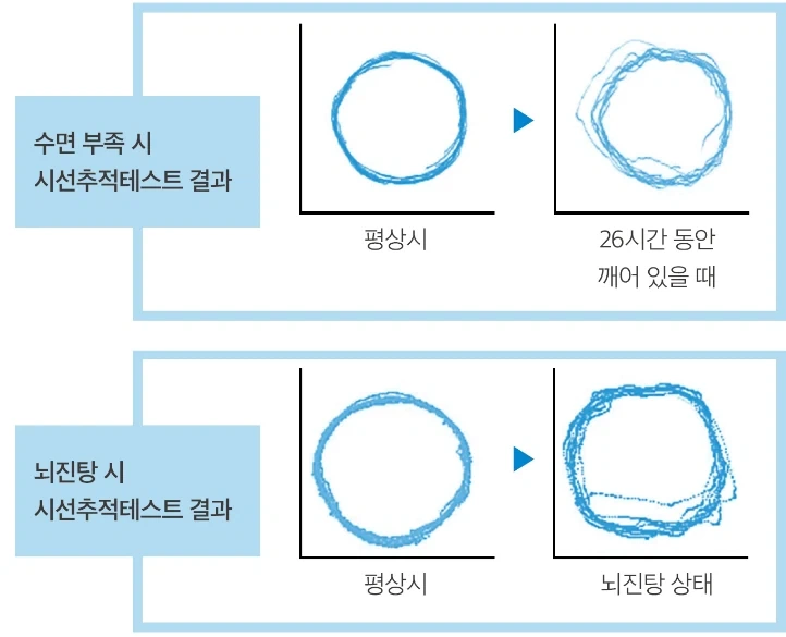 의외로 뇌진탕과 비슷한 상태라는 것.jpg - 이미지 2