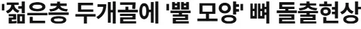 두개골에 뿔이 점점 자라나고 있다는 현대 인류.news - 이미지 2