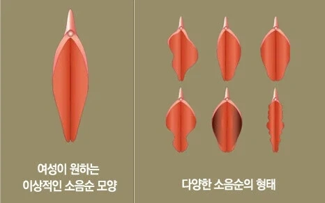 소음순 정리