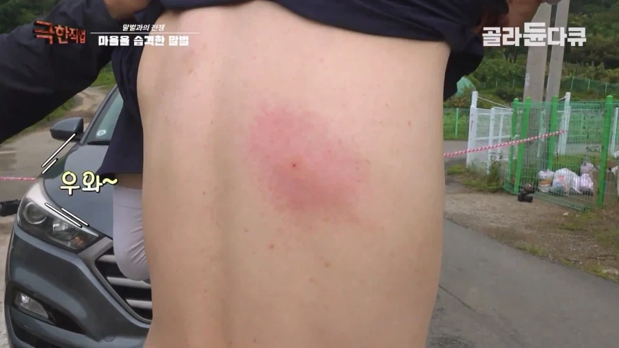말벌에 강하다는 벌꾼이 장수말벌에 쏘였을 때 - 이미지 12