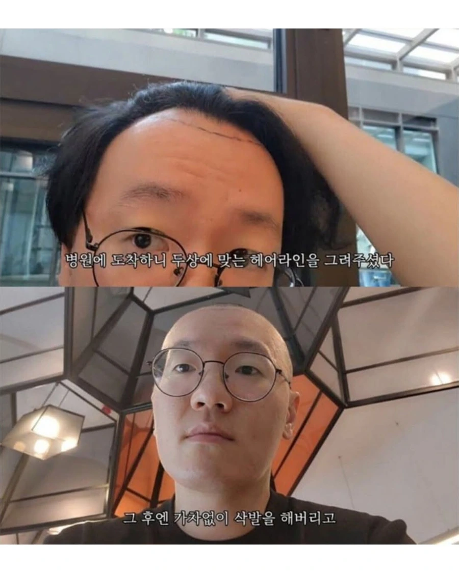 터키로 모발이식 받으러간 남자의 최후.jpg - 이미지 2