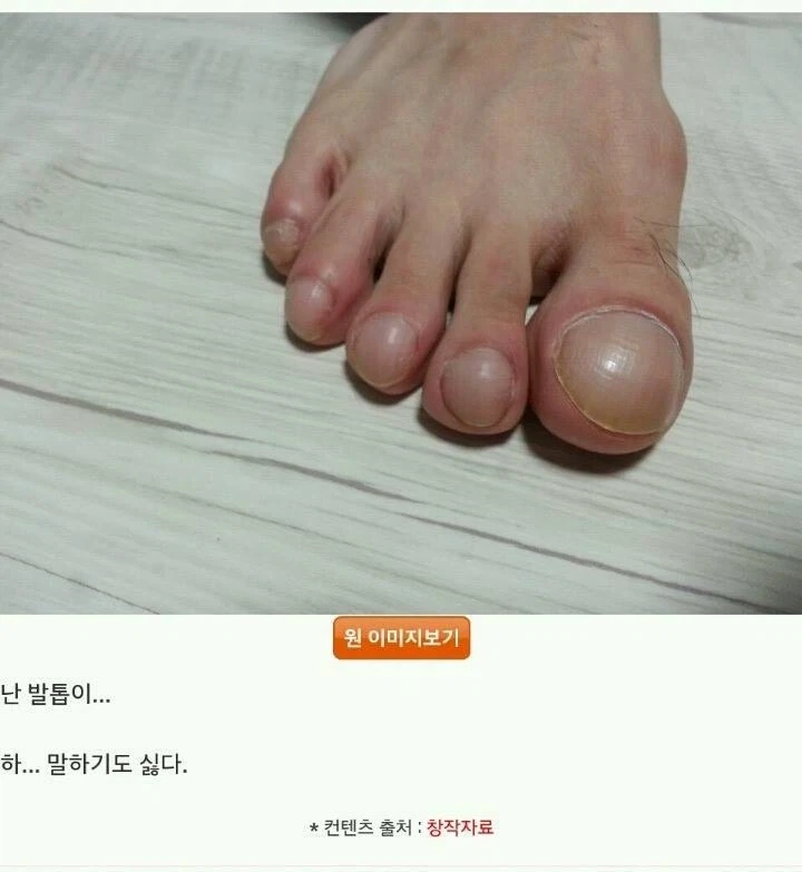 혐?) 발톱이 콤플렉스라는 사람