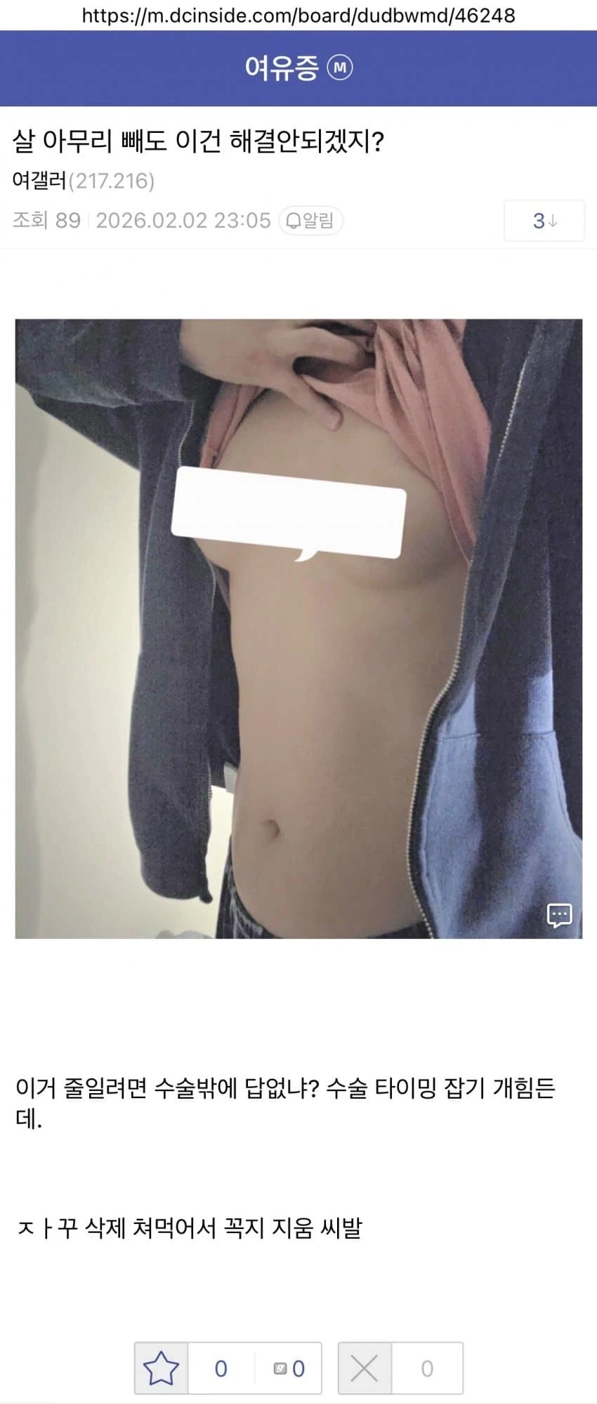 살빼도 안된다는 여유증 남자.jpg