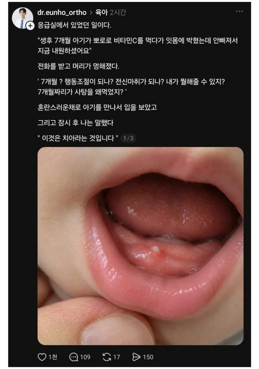 아기 잇몸에 사탕이 박혀 응급실에 감