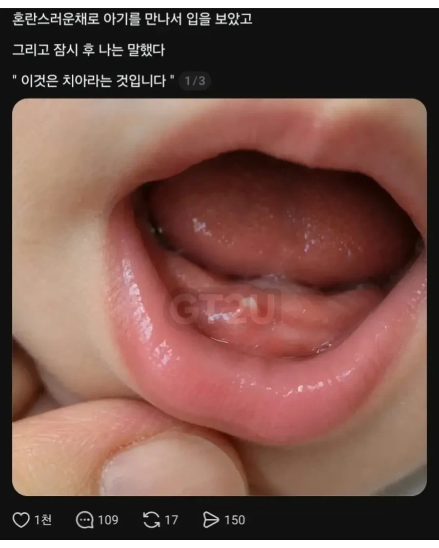아기 잇몸에 사탕 박혀 응급실 감 - 이미지 2