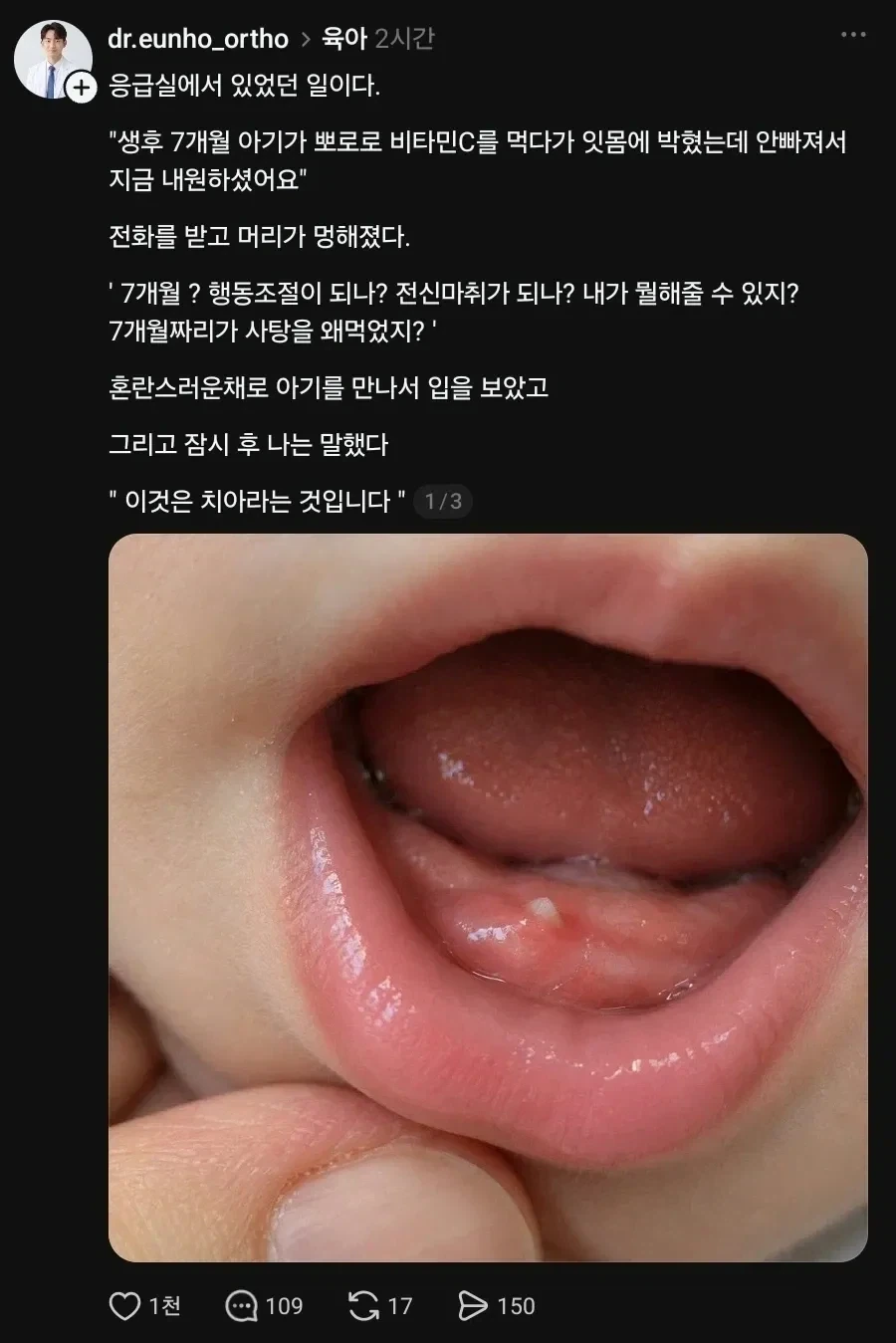 태어난지 7개월 된 애가 비타민 먹다 잇몸에 박혔는데 안 빠져요 ㅜㅜ.jpg