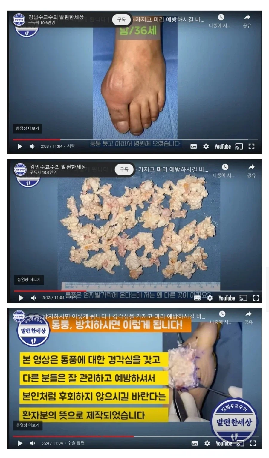 극혐) 몸에서 탕수육을 생산하는 통풍환자 수술