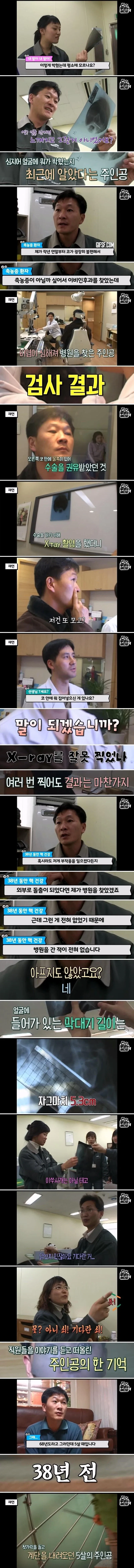 축농증 수술하러 갔다가 발견한 물건의 정체 - 이미지 2