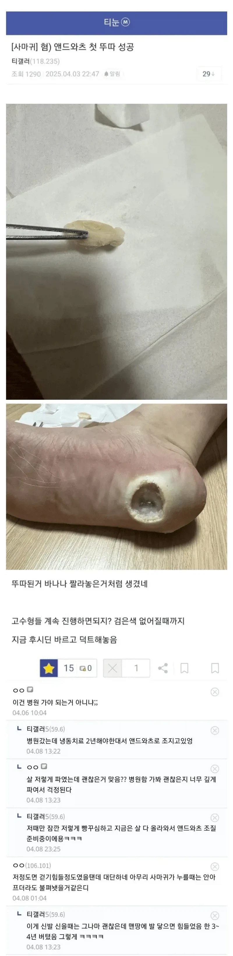 (혐) 발꿈치를 통째로 뽑아낸 인간
