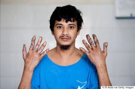 혐) 사마귀 질환이 잘못되면 발생하는..