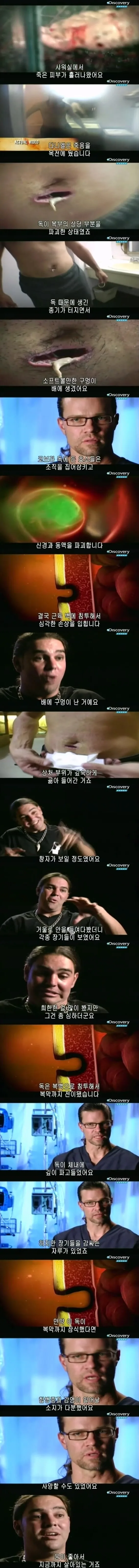 [극혐] 코브라한테 물려서 배에 구멍이 뚫린 청년.jpg - 이미지 10